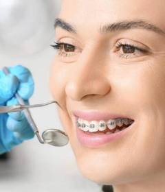 Брекет-системы для взрослых и детей