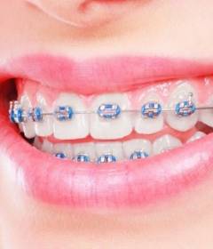 Брекеты для подростков 12 лет