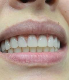 Имплантация зубов на верхней челюсти