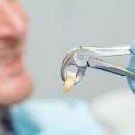  Что делать после удаления зуба: пошаговая инструкция от стоматолога 