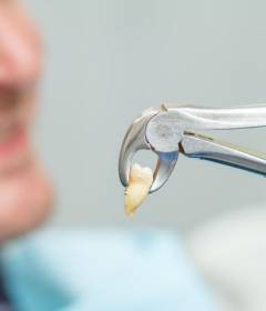 Что делать после удаления зуба