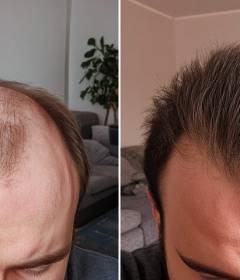 Что нужно знать о пересадке волос для мужчин