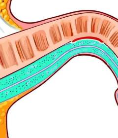 Что такое болезнь Пейрони?