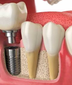 Можно ли имплантировать один зуб?	