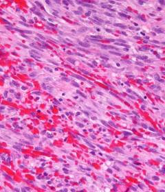 Саркома Капоши