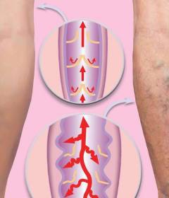 Варикозная болезнь нижних конечностей