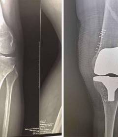 Операция по замене коленного сустава