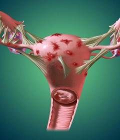 Эндометриоз - причины, симптомы, методы лечения