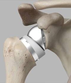 Эндопротезирование плеча