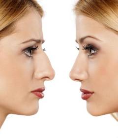 Интересные факты о ринопластике