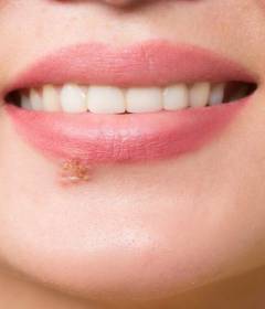 Как снизить частоту рецидивов герпеса