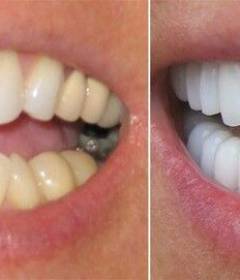 Керамические или композитные виниры