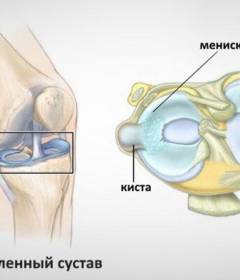 Киста менисков