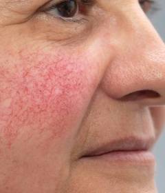 Купероз на лице