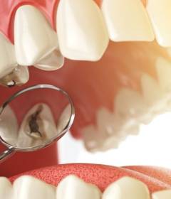 Лечение кариеса в домашних условиях