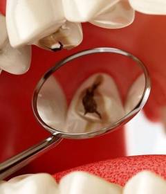 Лечение пришеечного кариеса