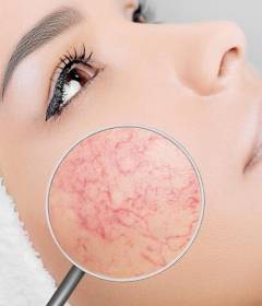 Лечение сосудистых патологий кожи