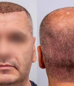 Методы пересадки волос