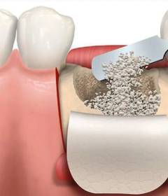 Наращивание костной ткани перед имплантацией