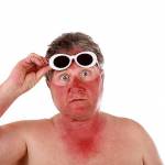  Солнечный ожог: 18 народных средств и рецепты применения 