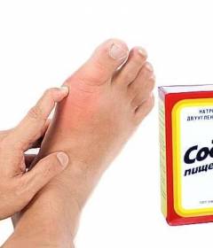 Лечение подагры пищевой содой