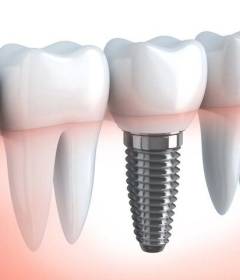 Доверьте установку имплантов профессионалам