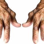  Ревматоидный артрит: симптомы и диагностика, 5 методов лечения 