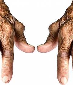 Ревматоидный артрит — симптомы и лечение