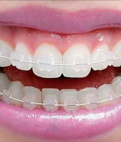 Почему брекеты – лучшее решение