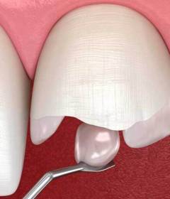 Современная реставрация зубов