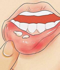 Стоматит во рту