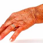  9 трав для лечения ревматоидного артрита 