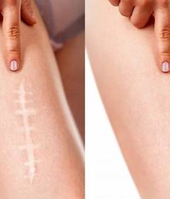 Удаление шрамов