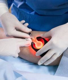 Лазерная операция варикоза вен на ногах