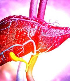 Жировой гепатоз печени