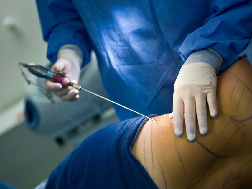 Миф №6: Липосакция — единственное спасение