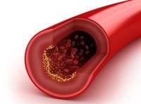 Нормализация уровня холестерина