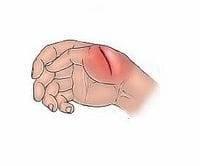 Заживляет раны