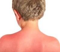 Солнечный ожог