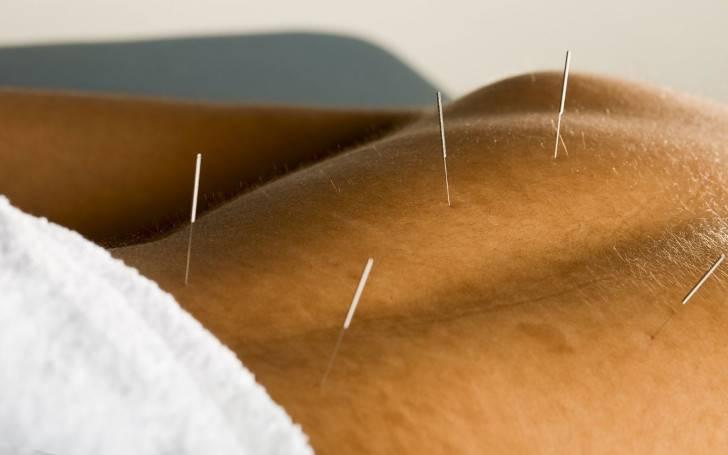 Аккупунктура