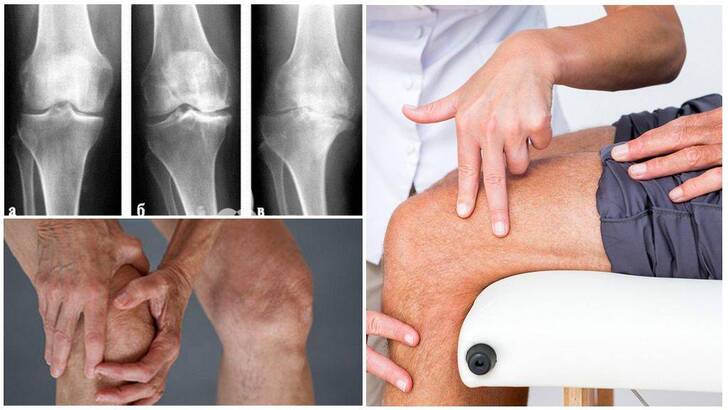 Прогноз при артрите коленного сустава