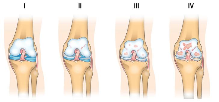 Стадии артрита колена