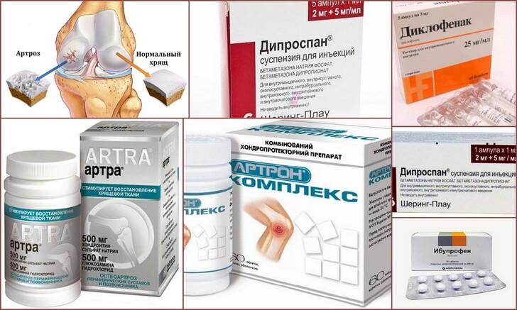 Медикаментозное лечение артрита коленного сустава