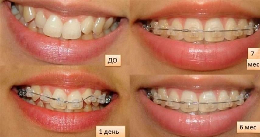 Выбор зависит от клинической ситуации, пожеланий подростка и рекомендаций врача