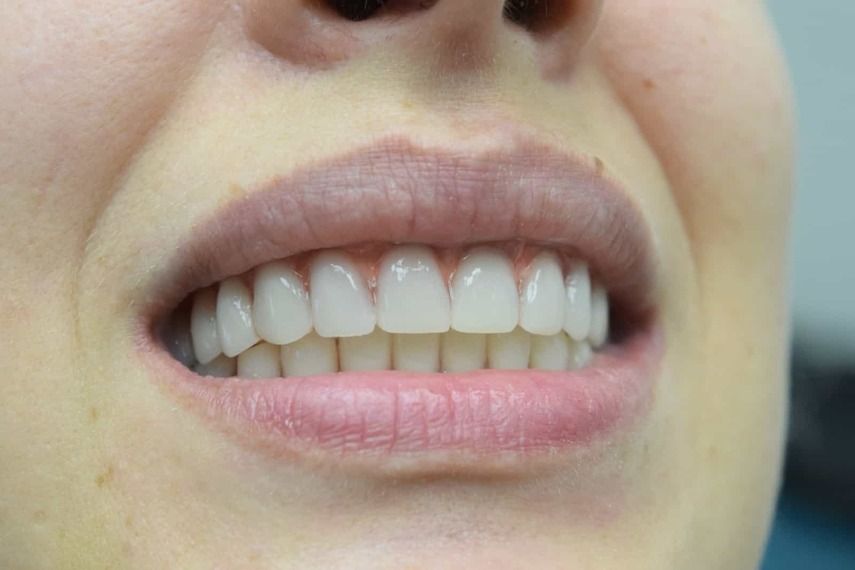 Частые проблемы при имплантации зубов на верхней челюсти