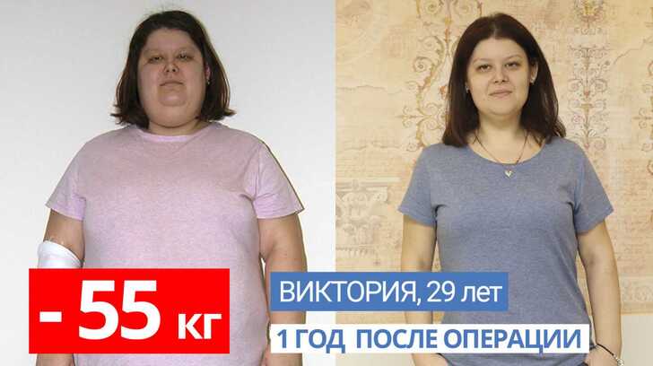 Эффект от бариатрических операций