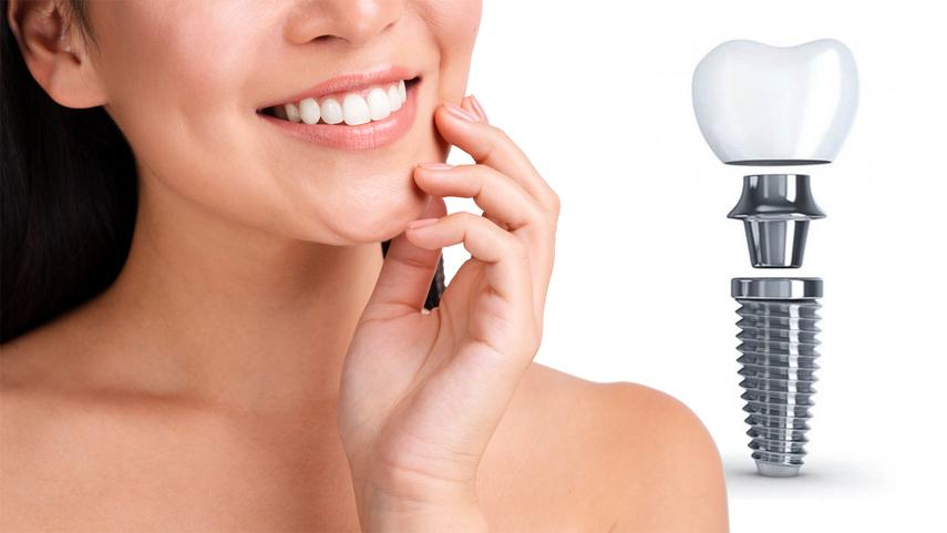 Одноэтапная имплантация