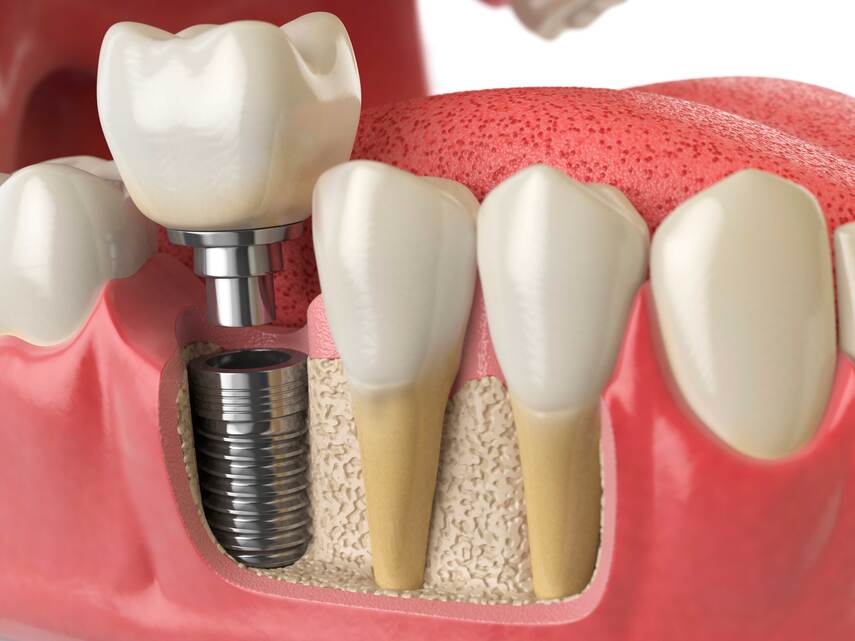Что такое имплантация зуба? Какая методика лучше для восстановления одного зуба?