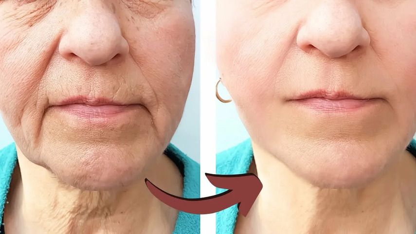 Механизм подтяжки кожи: как это работает?
