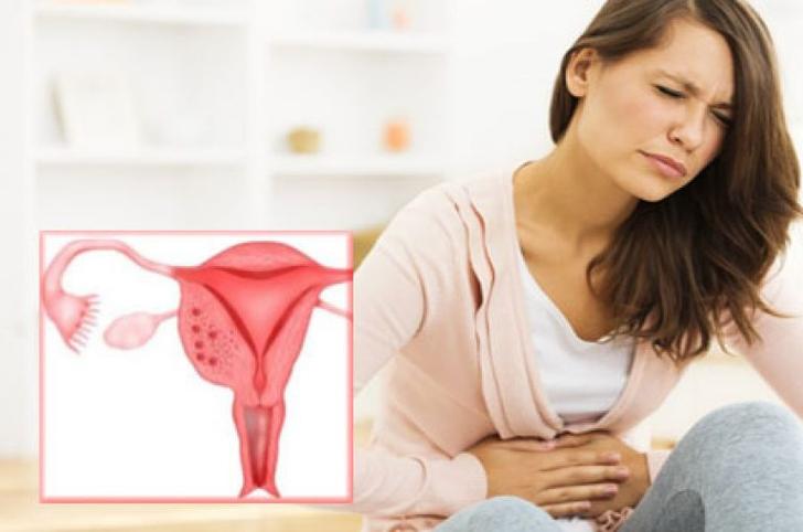 Что представляет собой эндометриоз: кратко о заболевании